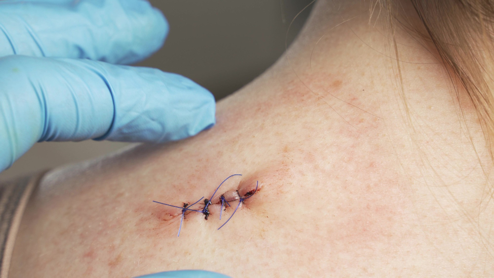 Stitches Removal in Flushing & Jamaica